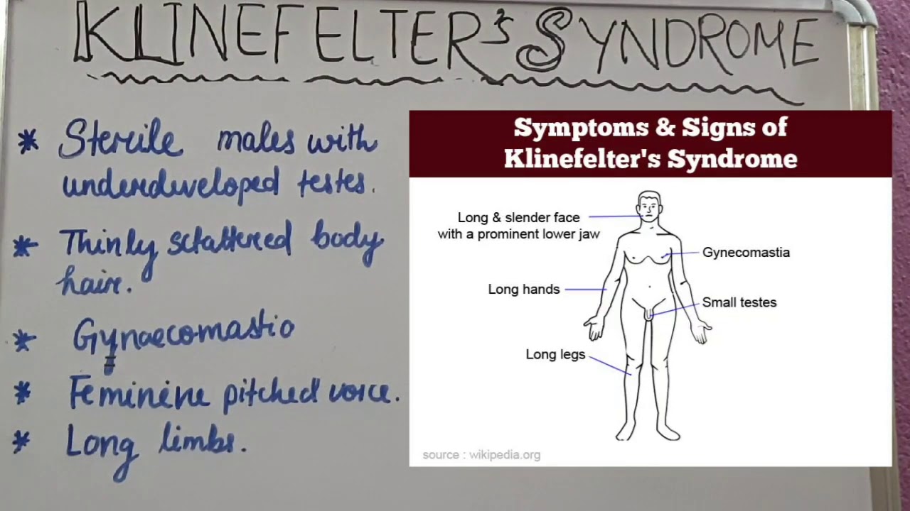 Klinefelter Syndrome Xxy Signs Symptoms Youtube