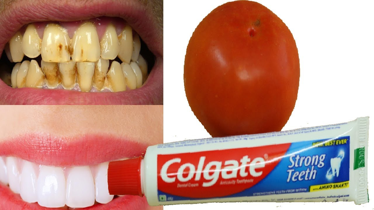 Teeth Whitening Home Remedy! 100 Working Whiten Teeth At Home