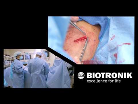 Cardiologist Discusses Implant Procedure for BIOTRONIK DX System*