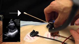 Precordial Movements: The Double Impulse