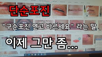 단순포진 , 구순포진 , 언제까지 연고만 ??... 피곤하면 입술에 뭐가 나요.