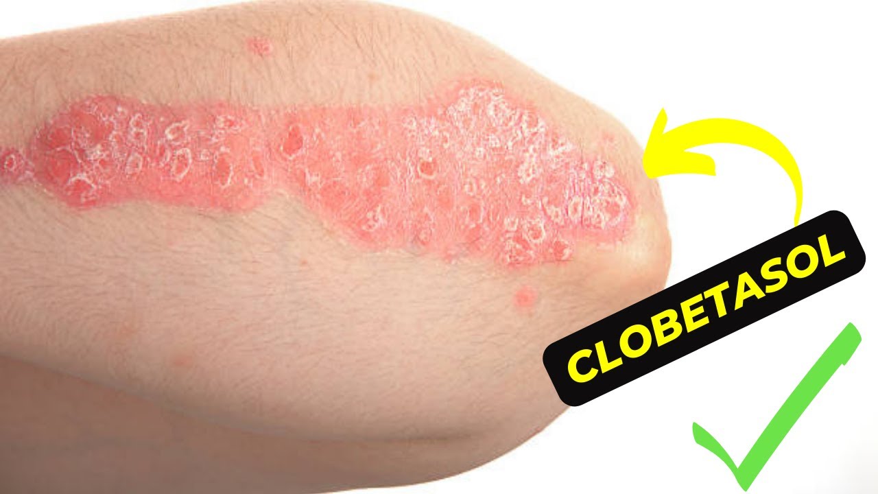 The ultimate guide to clobetasol how to effectively treat skin