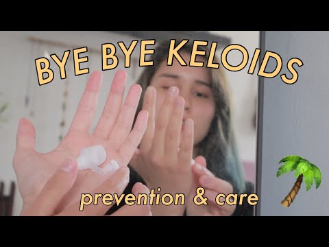 HOW TO TREAT KELOIDS | *piercing bump*
