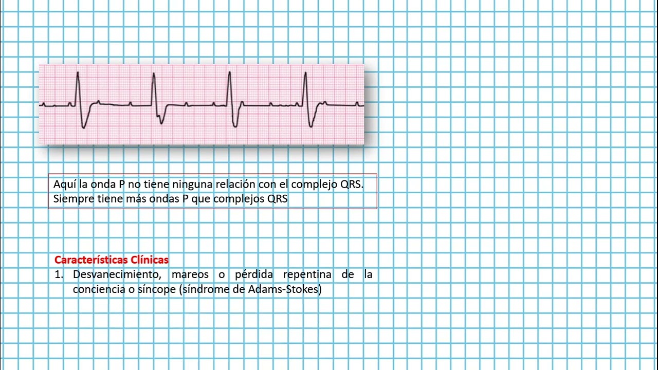 Bloqueo Av De Tercer Grado Clases Ekg 19 Youtube