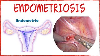 Endometriosis: rápido y fácil