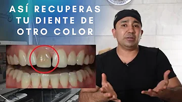 ¿Cuándo se ennegrecen los dientes?