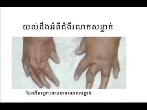 ជម្ងឺរលាកសន្លាក់ Arthrite