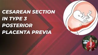 Cesarean Section In Type 3 Posterior Placenta Previa - Dr Shilpa G B