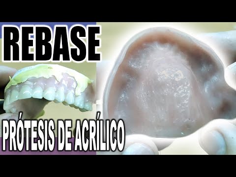 Video: ¿Delta dental cubre los rebases de dentaduras postizas?