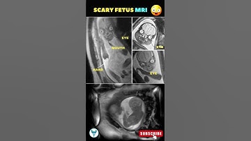 Baby MRI | Fetal scan | Pregnancy week by week #pregnancy #mri #sonography