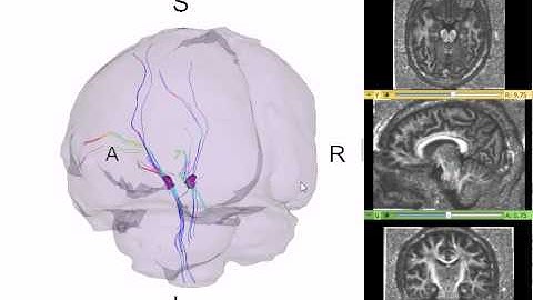 Ventral Tegmental Area - DTI of the Dopaminergic pathway