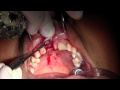 CAMLOG Implant Placement #8 &amp; Concurrent GBR Grafting with Mineross &amp; d-PTFE