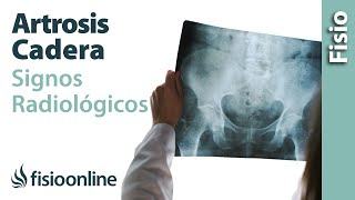 A csípőízületek coxarthrosisának kezelése 2-3 fokkal. Ortopédia jegyzet | berekviraga.hu