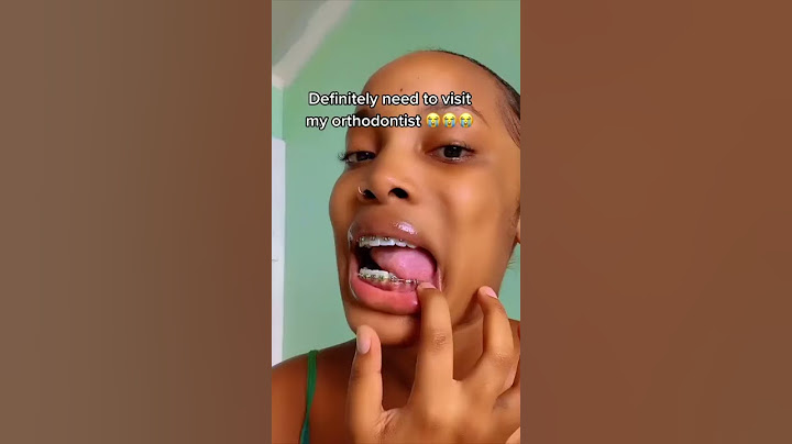She Broke Her Braces And Did WHAT?!?! 😳 Orthodontist Reacts