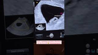 6 Weeks Pregnancy Scan Watching Babys Heartbeat For First Time