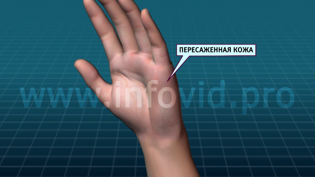 ожог пересадка кожи
