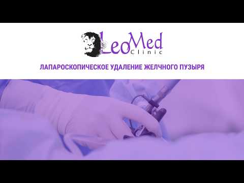 Удаление желчного пузыря