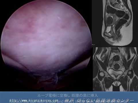 子宮底部筋腫子宮鏡下摘出術(TCR)　Roller ball hysteroscopic technique      for fundal submucous myoma