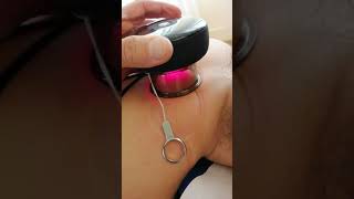 Electric cupping device application