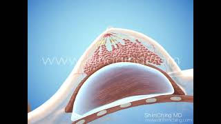 Breast Augmentation Animation