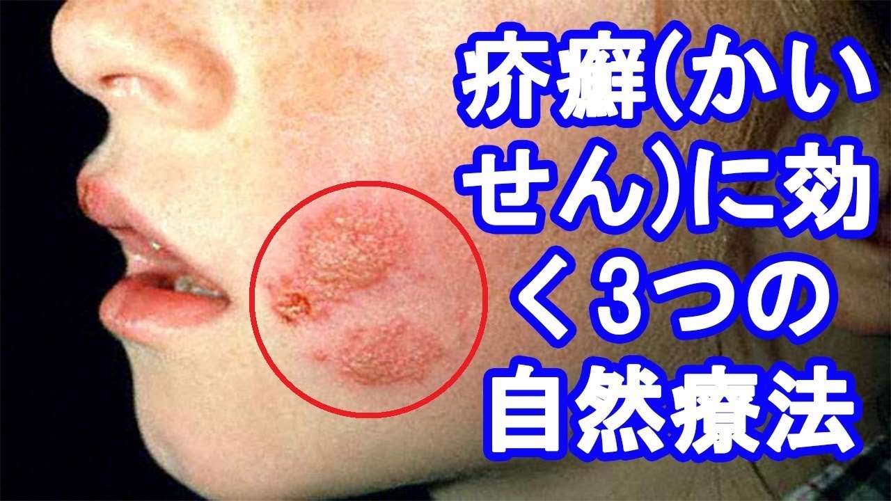 疥癬治癒, 疥癬 ヒゼンダニ – IKBR