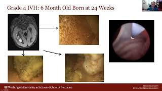 Neurosurgery On The Go Post-Hemorrhagic Hydrocephalus