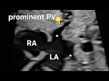 Prominent Pulmonary Vein + Echogenic Intracardiac Focus: A Benign Finding on Fetal Echocardiography