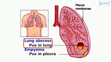 lung abscess
