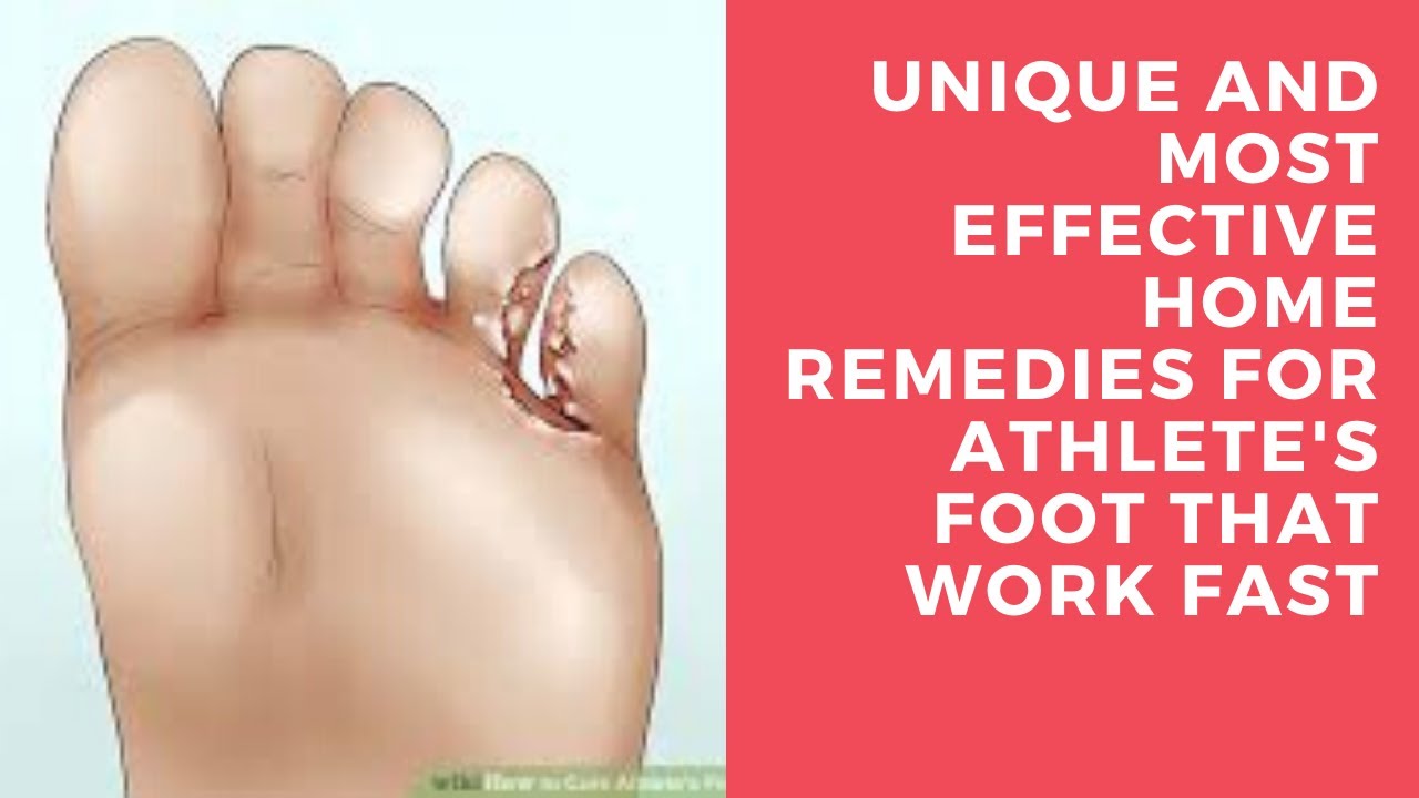 ATHLETE'S FOOTAthlete's foot home remedy(2020)Athlete's foot causes