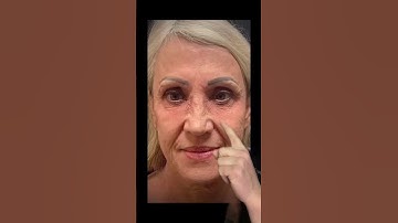 Thumbnail of Derm reacts to phenol peel! #phenolpeel #dermreacts #doctorreacts