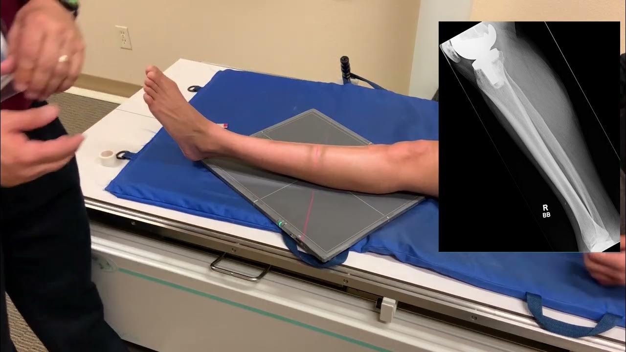 Tib Fib AP and Lateral X Ray Positioning YouTube
