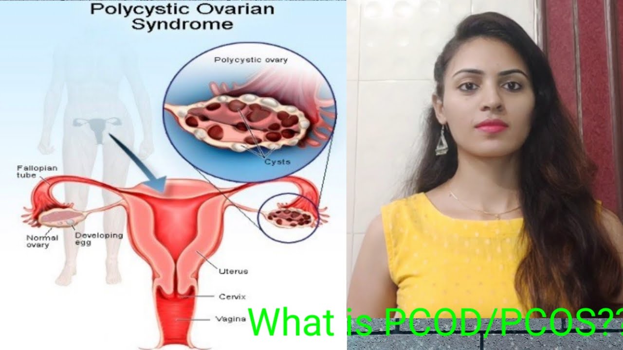 Pcod Paining Part Know about PCOD/PCOS in detail and its symptoms (Part -1) - YouTube