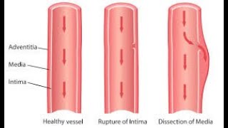 Famous Dissection CPT code - simplify medical coding Wealth