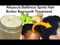 I Am Still Shocked 😳!, With This Ginger and Amla For Baldness Spots Regrowth Butter Treatment