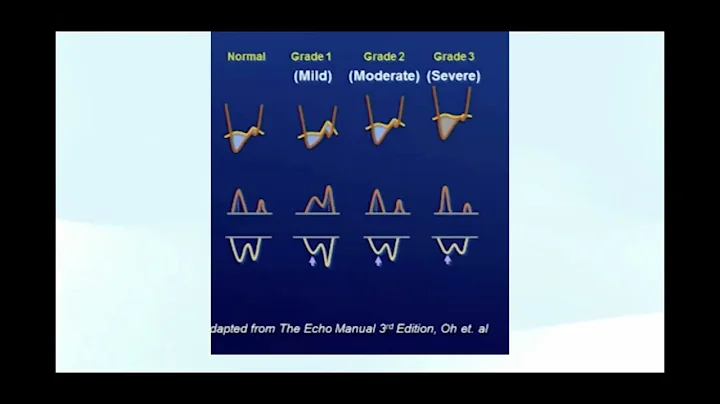 Measuring and Grading Diastolic Dysfunction using Echocardiography - Diastology!
