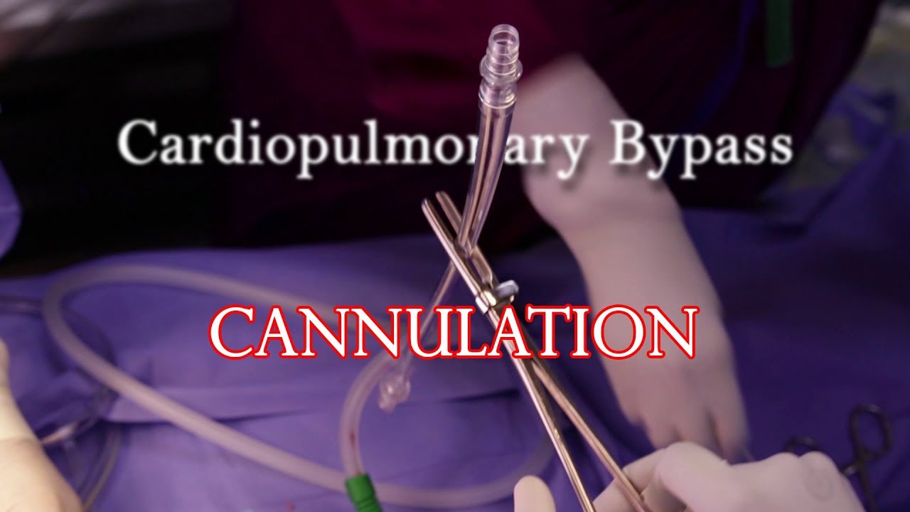 cardiopulmonary bypass cannulation