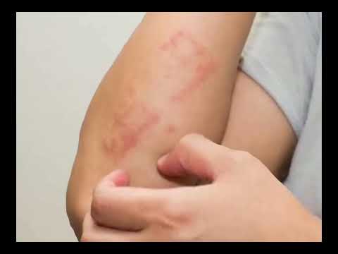 لوراتادين ١٠ ملغ مرة في اليوم