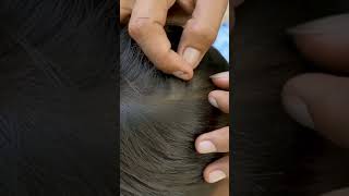 removing thousand of lice from head getting all  lice out black long hair