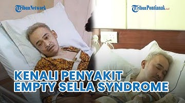 🔴 Kenali Penyakit Ruben Onsu, Gejala Penyakit Empty Sella Syndrome