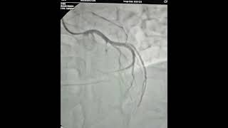 Primary Angioplasty & Stenting Procedure to LAD via Right Radial Artery | Best Cardiac Hospital Agra