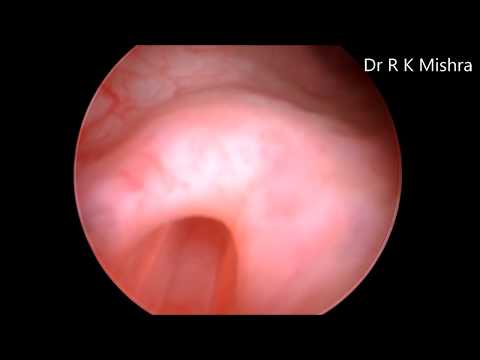 infrared-ureteral-stenting-in-gynecological-laparoscopy