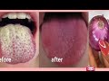 How to Get rid of White Tongue and Bad Breath Instantly / How to Get a Pink Tongue Fast 100% Works