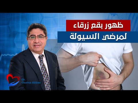 سبب ظهور بقع زرقاء على الجسم عند تناول أدوية السيولة دكتور اسامة عباس
