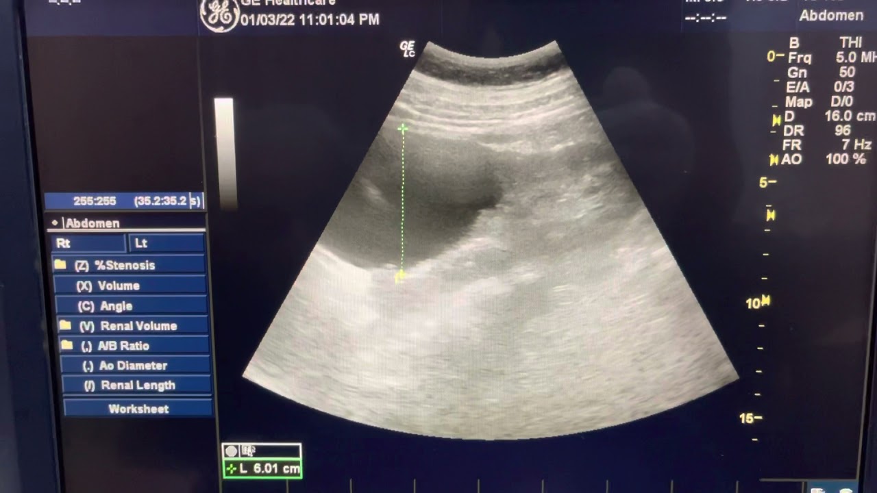 شرح عام عن سونار البطن U.S for abdomen للاستاذ الدكتور محمد مجذاب الربيعي￼