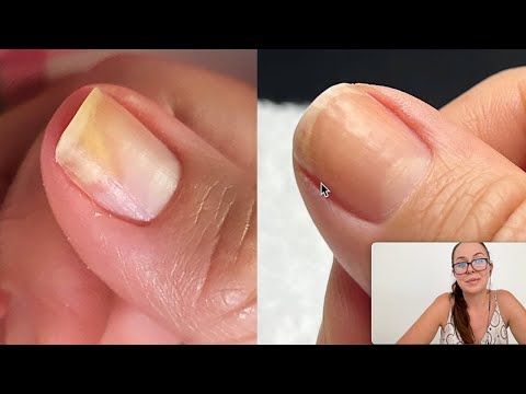 A bruise on my nail turned out to be cancer but I get free manicures |  Metro News
