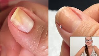 How she regrew her separated nail. [Onycholysis]