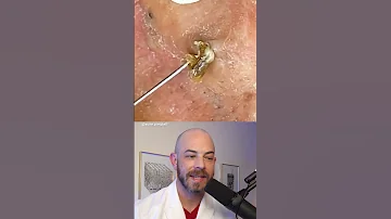 Derm Reacts To BIG Blackhead Removals Behind The Ear Dermreacts Doctorreacts Blaclheadextraction 