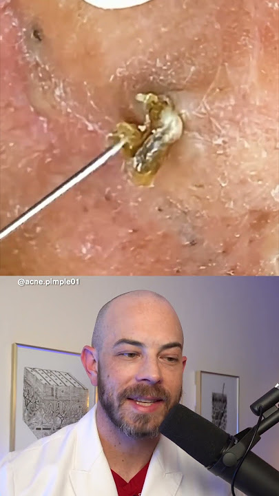 Derm reacts to BIG blackhead removals behind the ear! #dermreacts #doctorreacts #blaclheadextraction