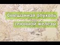 Смешанная опухоль слюнной железы (плеоморфная аденома) | Патанатомия