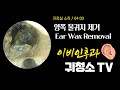 양쪽 물귀지 제거 (Ear Wax Removal)